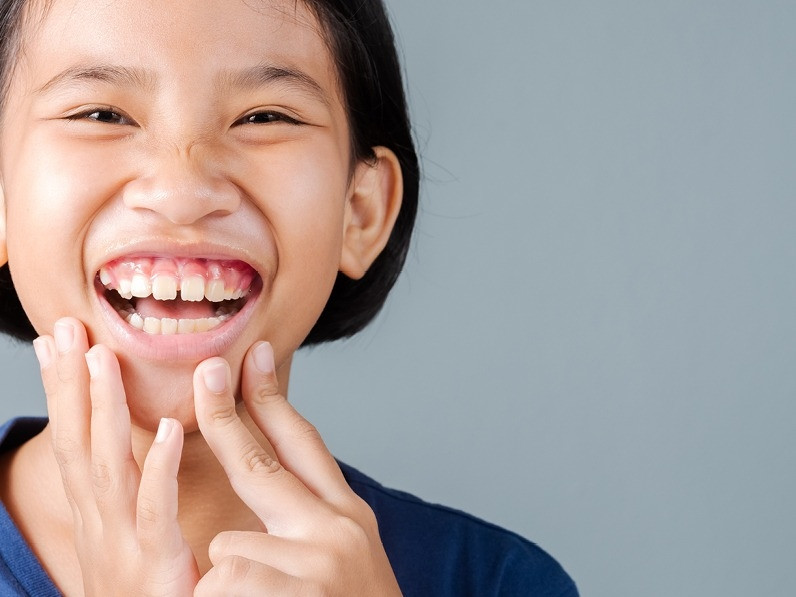 Come correggere il sorriso gengivale|Dentisti Trapani Di Maio Sorrento