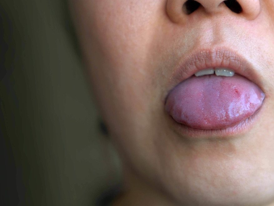 Perchè  ci si morde la lingua|Dentisti Trapani Di Maio Sorrento