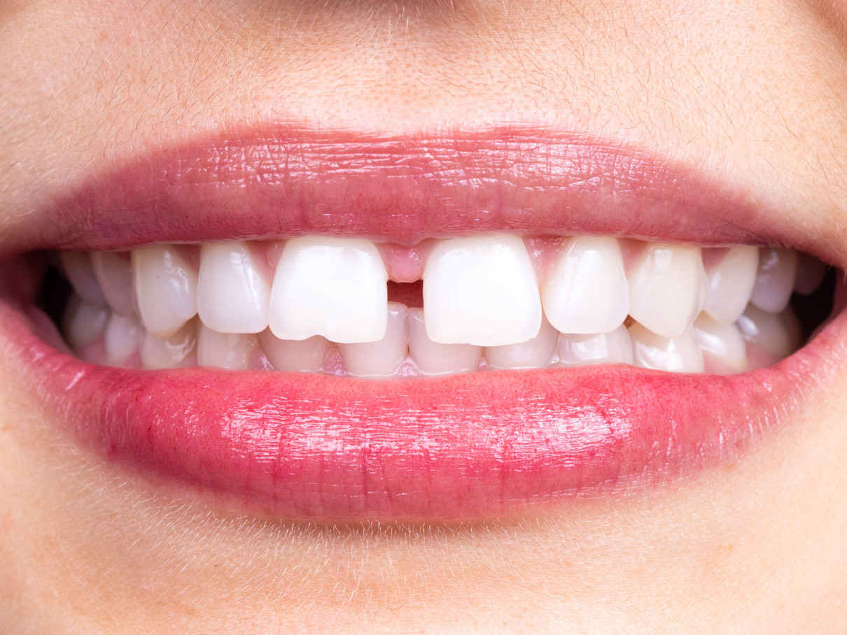 Che cos'è il diastema?|Dentisti Trapani Di Maio Sorrento