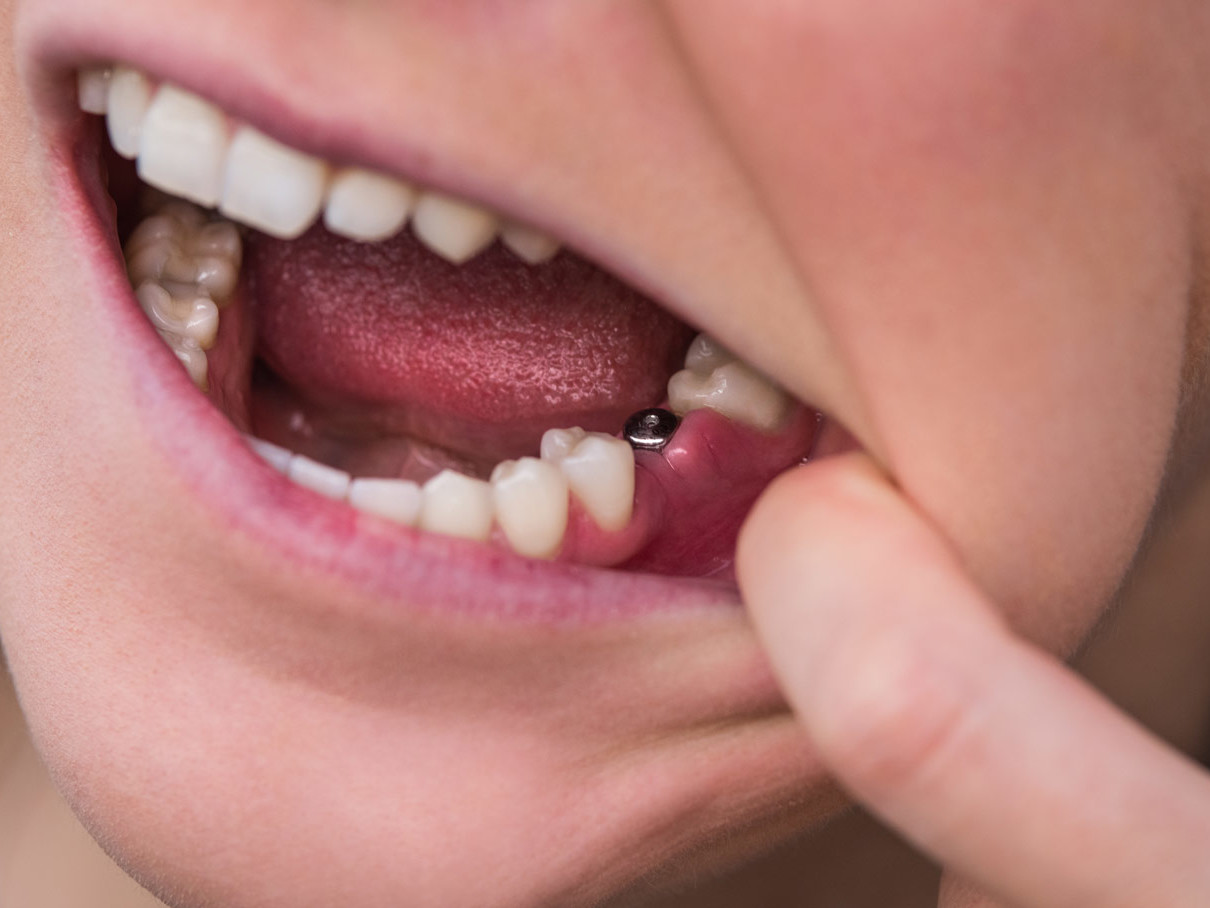 Perché è necessario sostituire i denti mancanti?| Dentisti Trapani Di Maio