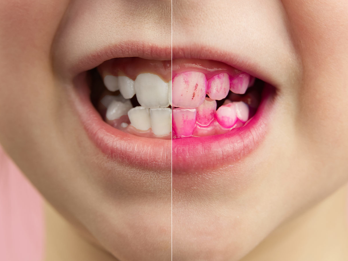 I rilevatori di placca dentale | Dentisti Trapani Di Maio Sorrento