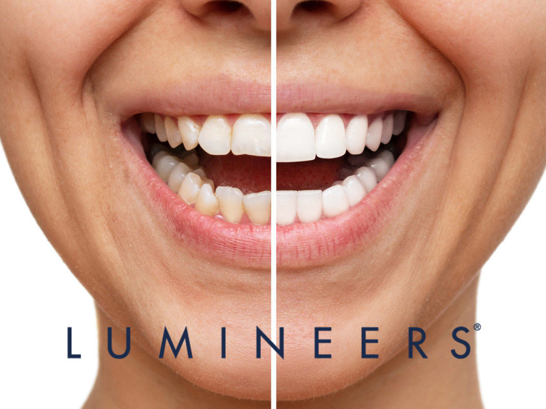 Faccette dentali Lumineers Sorrento| Dentisti Trapani Di Maio Sorrento