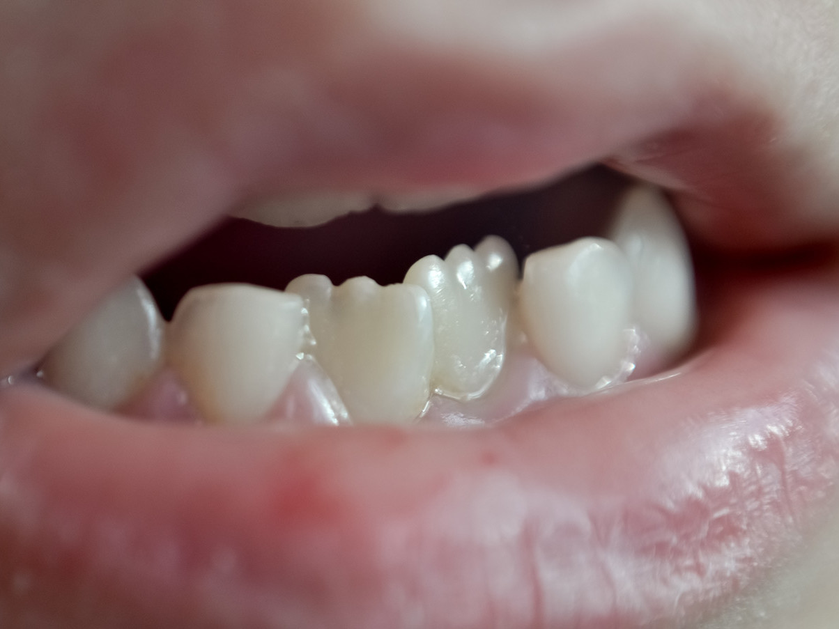 Affollamento dentale: cause e conseguenze| Dentisti Trapani Di Maio